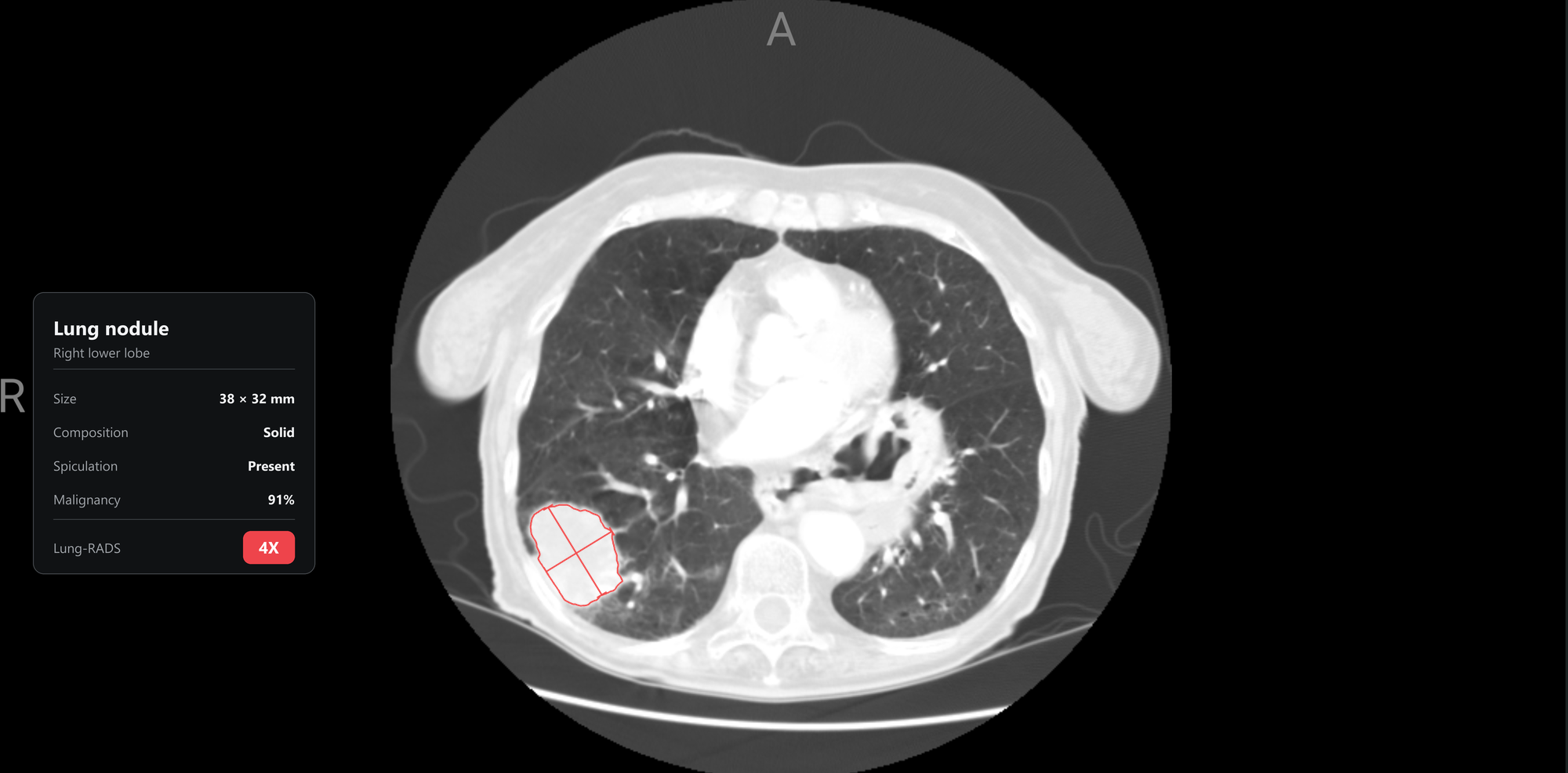 Illustrative AI assessment of a pulmonary nodule in chest CT