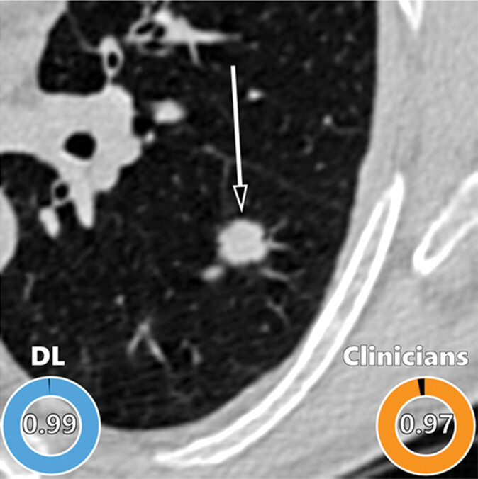 Axial CT slice with an arrow marking a spiculated nodule, scored 0.99 by the algorithm and 0.97 by the clinicians