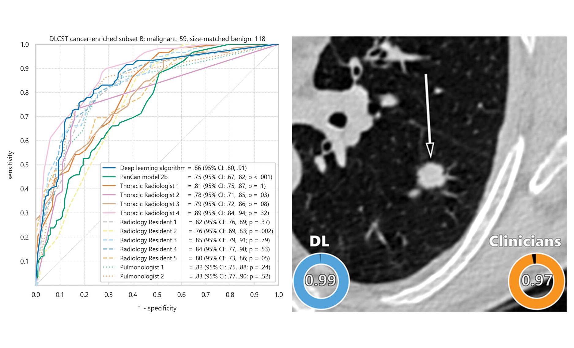 Pulmonary nodules malignancy prediction in CT images